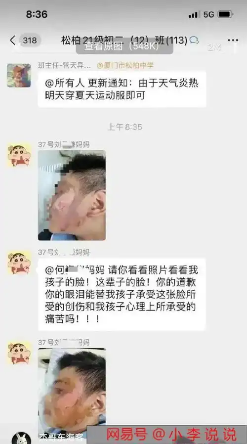 厦门中学男生被女生泼开水毁容,女生以抑郁症做挡箭牌逃脱责罚
