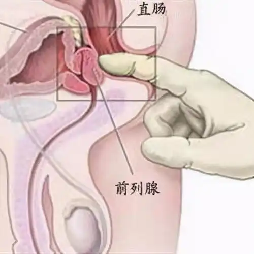 随着男性年龄变化,前列腺的生长状况,以及前列腺增生前列腺癌
