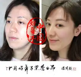 中国好鼻子同框,盘点刷屏朋友圈的男女版隆鼻靓照
