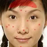 痘痘女孩头像搞笑满脸痘痘的女生头像微信头像图片大全
