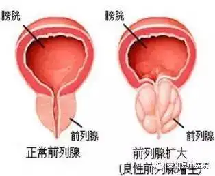 老年男性尿频尿急尿痛怎么办
