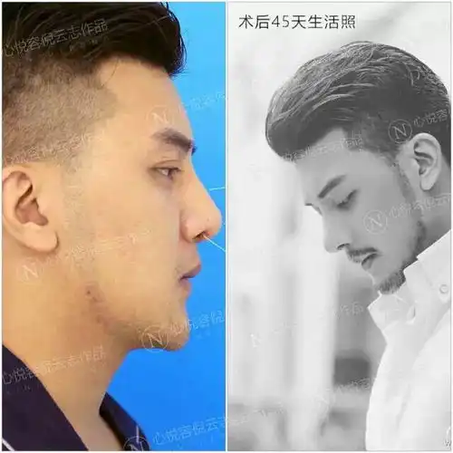 男士整形是娘炮直男...
