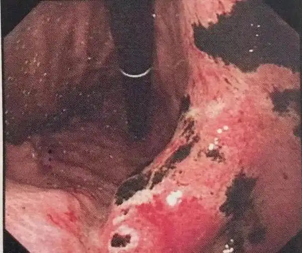 12岁男孩查出胃癌晚期,妈妈一番话,让医生怒斥不配做父母
