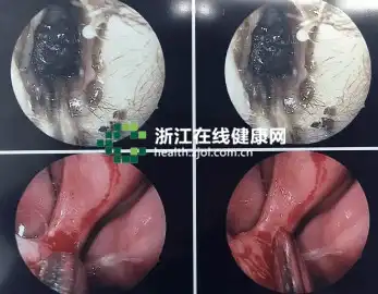 5岁孩子成了臭鼻怪他鼻腔里竟装了一颗纽扣电池

