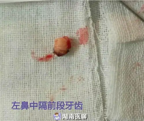 15岁少年的苦恼鼻子老不舒服鼻腔里长了颗异位牙
