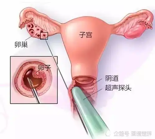18岁女大学生15w卖卵子,为购买iphone和苹果电脑
