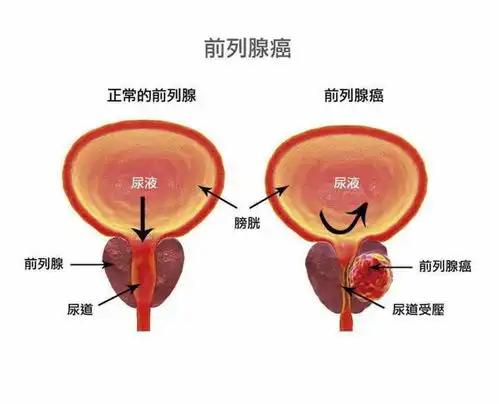 科普思前想后前列腺癌筛查这件事

