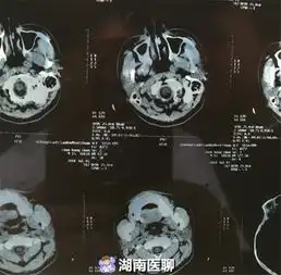 衡阳15岁少年鼻子老不舒服因鼻腔里长了颗异位牙
