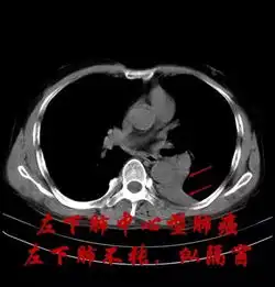 吸烟者必读你离肺癌有多远
