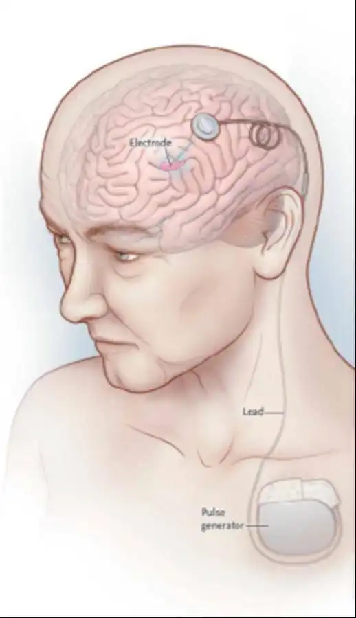恋爱失败后患严重强迫症,脑深部电刺激术助男子闯过十年情关
