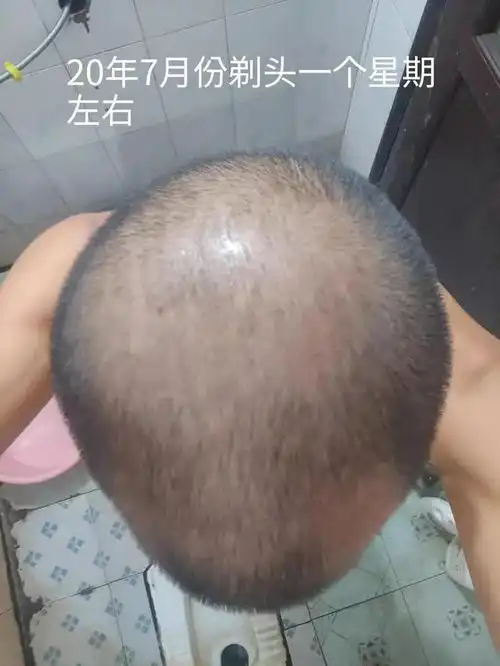 95年老男孩脱发一年的变化
