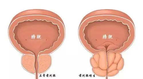 前列腺增生有哪些潜伏的信号做好10个预防,守护男性健康
