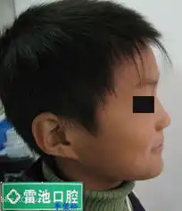 有些矫正病例拔牙要慎重后续u674e望松
