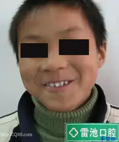 有些矫正病例拔牙要慎重后续u674e望松
