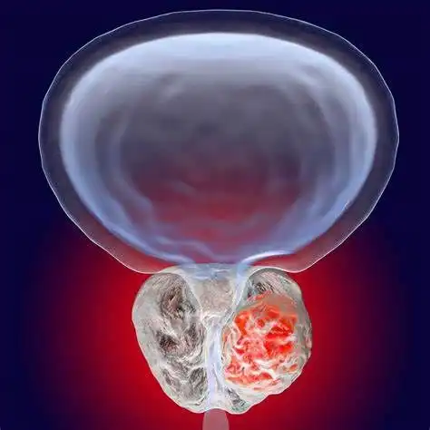 转移性去势敏感性前列腺癌mcspc新药强生erleada安森珂r,阿帕他胺显著延长总生存期os
