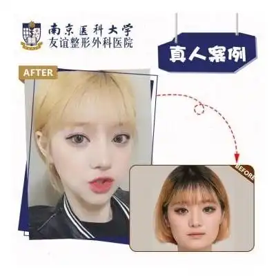 磨下颌角下颌角截骨清新萌系小v颜抖音ins网红同款悦美整形
