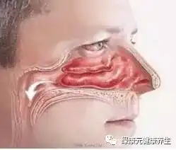 冬病夏治,中医调理彻底告别过敏性鼻炎适合男女老少
