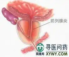 前列腺囊肿如何用食疗法治疗
