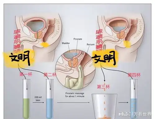 中医治愈前列腺炎,一位男子的故事
