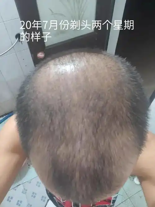 95年老男孩脱发一年的变化
