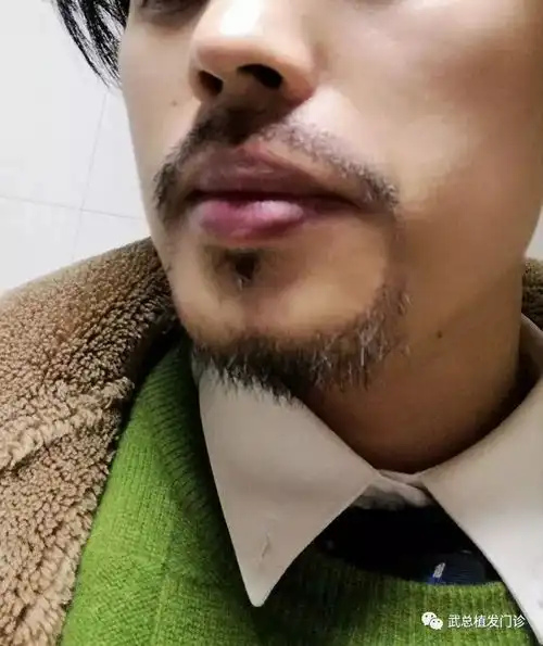 帅到没朋友33型男的华丽蜕变,胡须种植日记记录全过程

