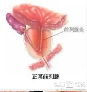 前列腺囊肿治得好吗
