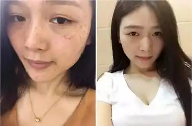黄褐斑的简单去除方法有哪些见证真人祛斑真实过程
