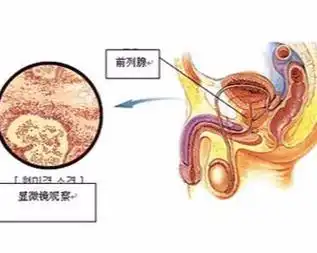 前列腺病
