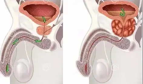 男性前列腺增生的原因是什么
