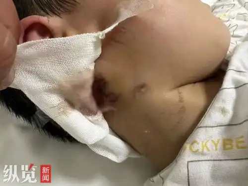 男童被狗咬伤18天后离世,半天内已注射疫苗和免疫球蛋白,为何还发病
