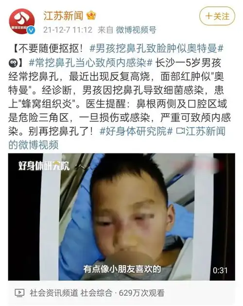 5岁男孩挖鼻孔致细菌感染,脸肿似奥特曼
