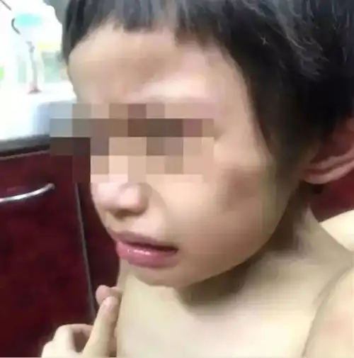 3岁男孩被全裸拴在阳台,饿到皮包骨抓粪便吃孩子跟着爸爸和其女友居住
