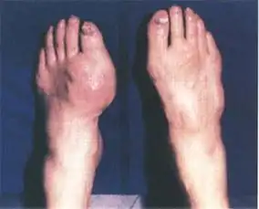 严重类风湿性关节炎手烂图片
