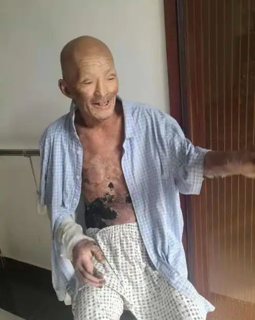 孤老汉被烧成重伤生命垂危,经安养院安宁疗护后转危为安
