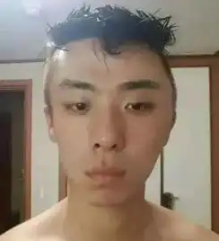 染发后脑袋肿成外星人,疑用劣质染发剂过程恐怖广州人你还敢染发吗
