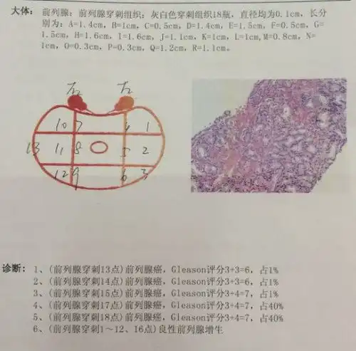 老年男性必备常识教你读懂前列腺癌的标记物psa
