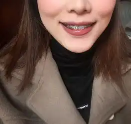 大龄女青年,牙齿正畸并拔牙的过程和感觉
