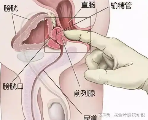 中医治疗慢性前列腺炎的绝佳老方子
