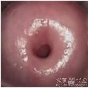 宫颈糜烂的原因
