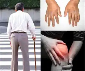严重类风湿性关节炎手烂图片
