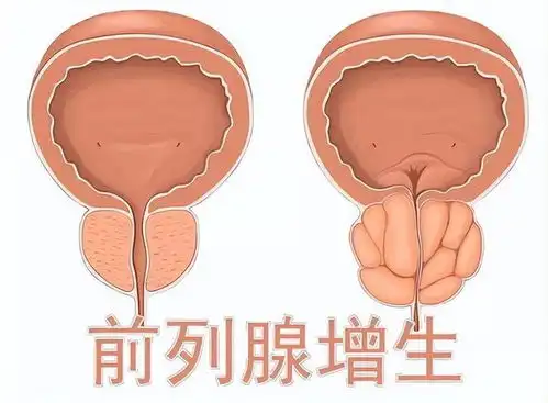 悄然发生的改变前列腺增生对男性危害有多大这些信号不容忽视
