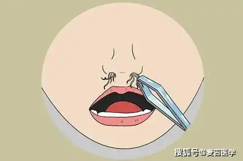 鼻毛窜出来了,真尴尬要不要拔掉它医生给你几点建议
