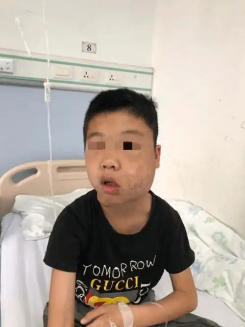 12岁男孩睡梦中突发出血命悬一线只因得了这种病
