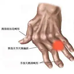 类风湿关节炎图片

