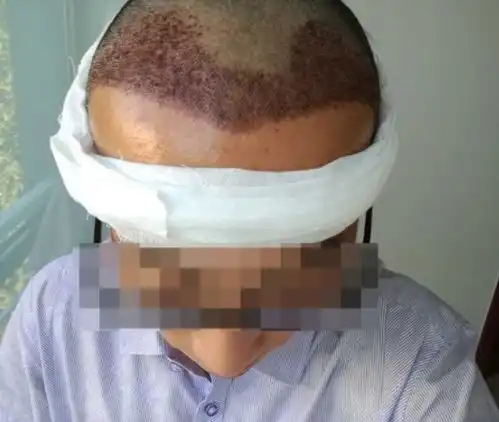 男性脱发应该怎么治疗效果更好
