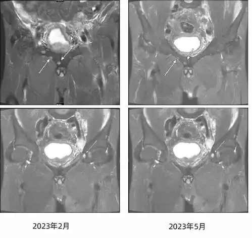杨彬教授伴骨转移的激素敏感性前列腺癌治疗及骨保护剂应用的临床探索
