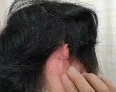 年前烫染发过敏患者增多,头等大事要小心
