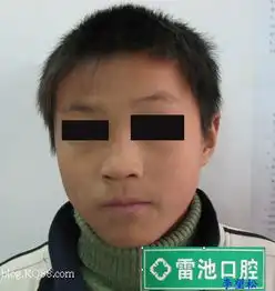 有些矫正病例拔牙要慎重后续u674e望松

